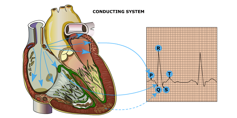 Arrhythmia