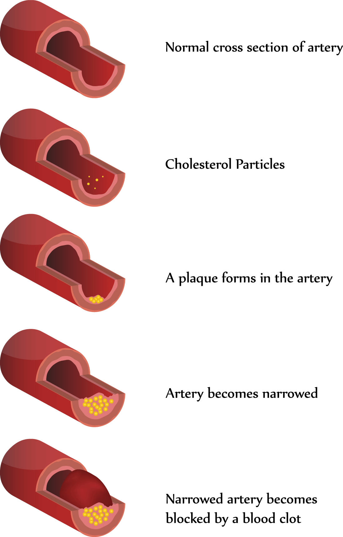 coronary
