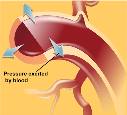 Arrhythmia