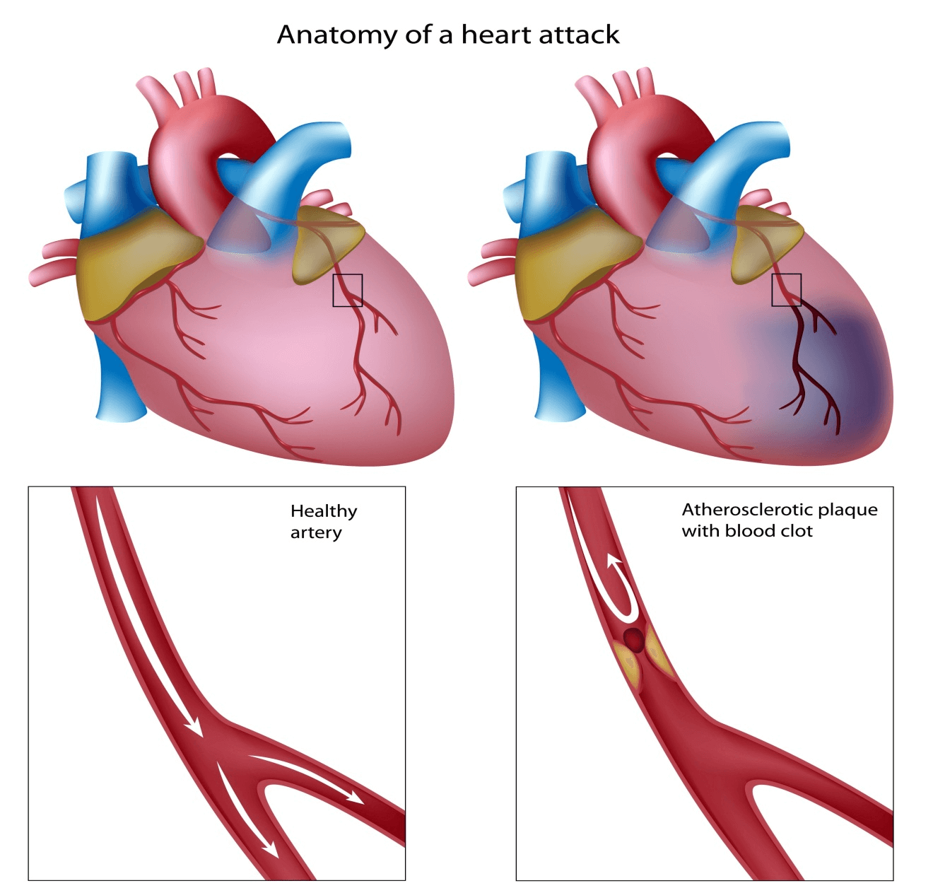 Arrhythmia